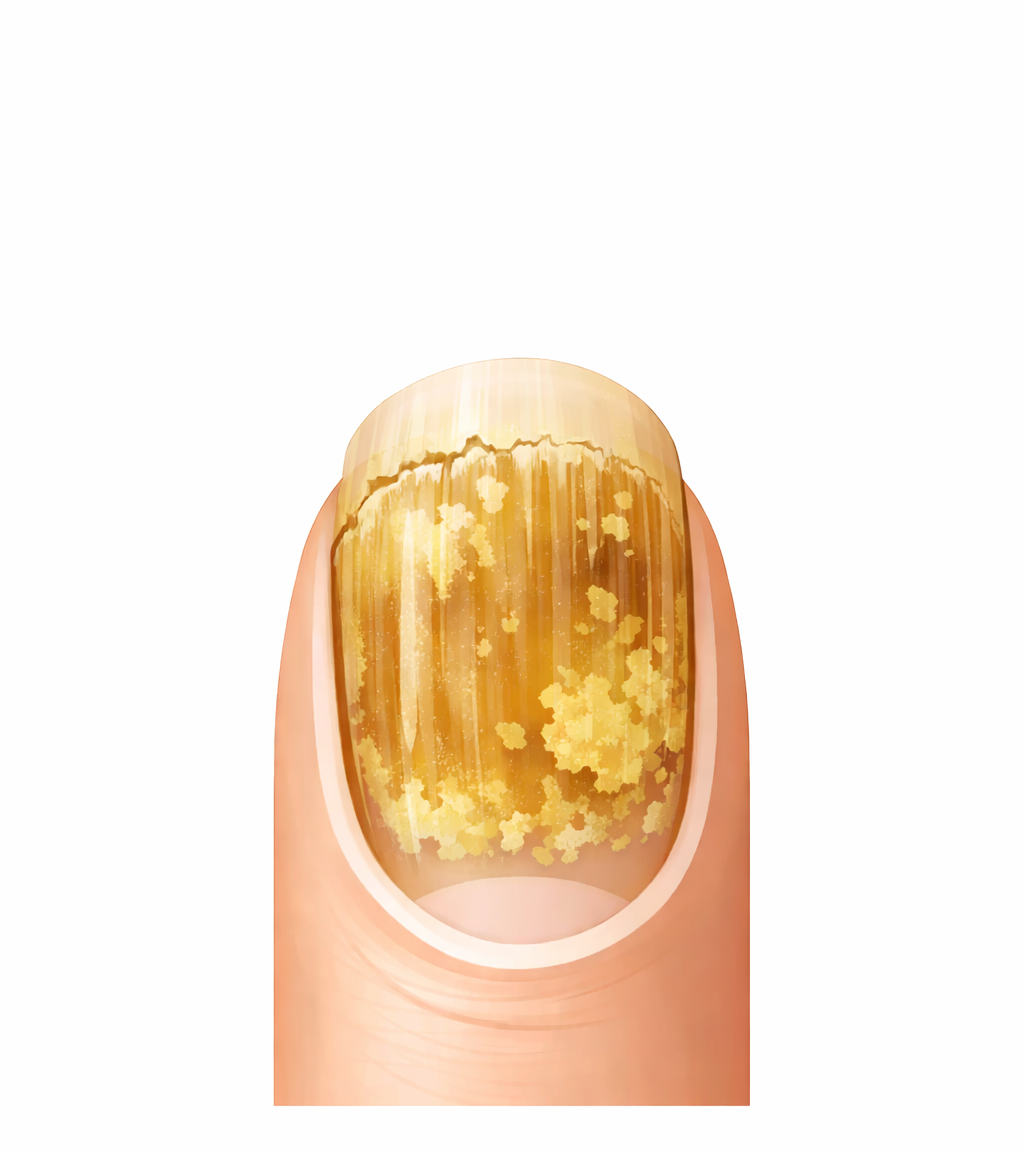NAIL FUNGUS?