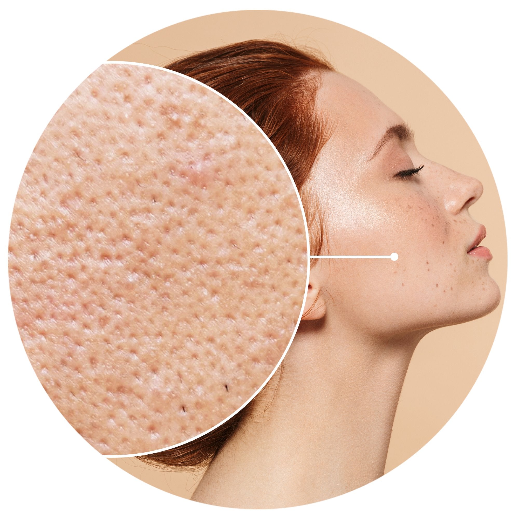 DILATED PORES?