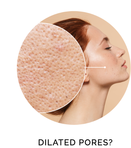 DILATED PORES?