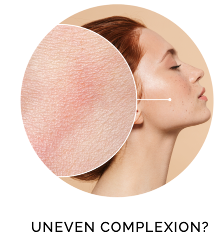UNEVEN COMPLEXION?